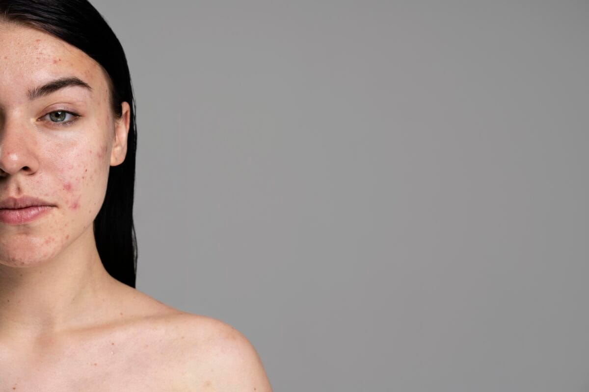 zabiegi na trądzik